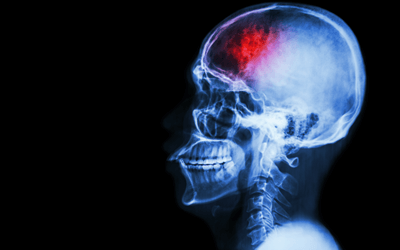 「脳梗塞」の原因と分類別の患者の症状
